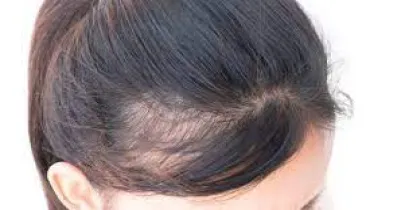 Hair Fall Treatment: How to Prevent Hair Loss in Winter with Simple Tips